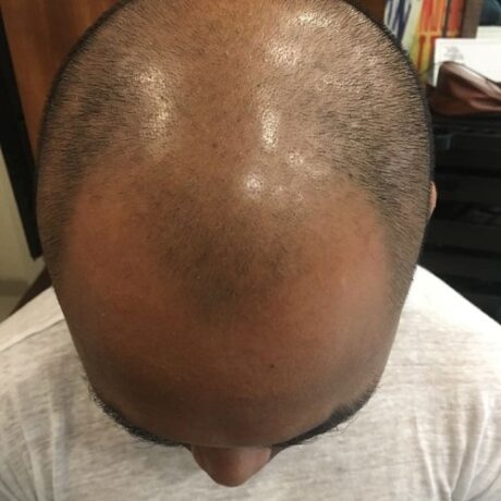 Men’s Toupee2-500×500